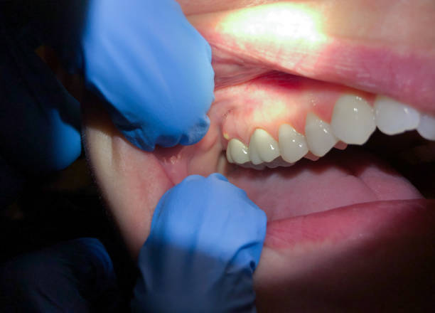 Best Emergency Dentist for Knocked-Out Tooth in Wickenburg, AZ